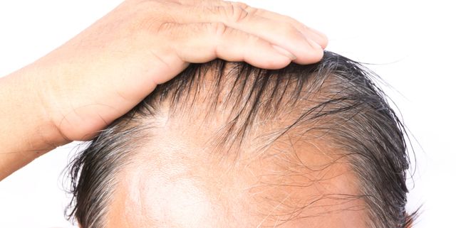 Folliculitis Decalvan Hair Thinning At Crown Female