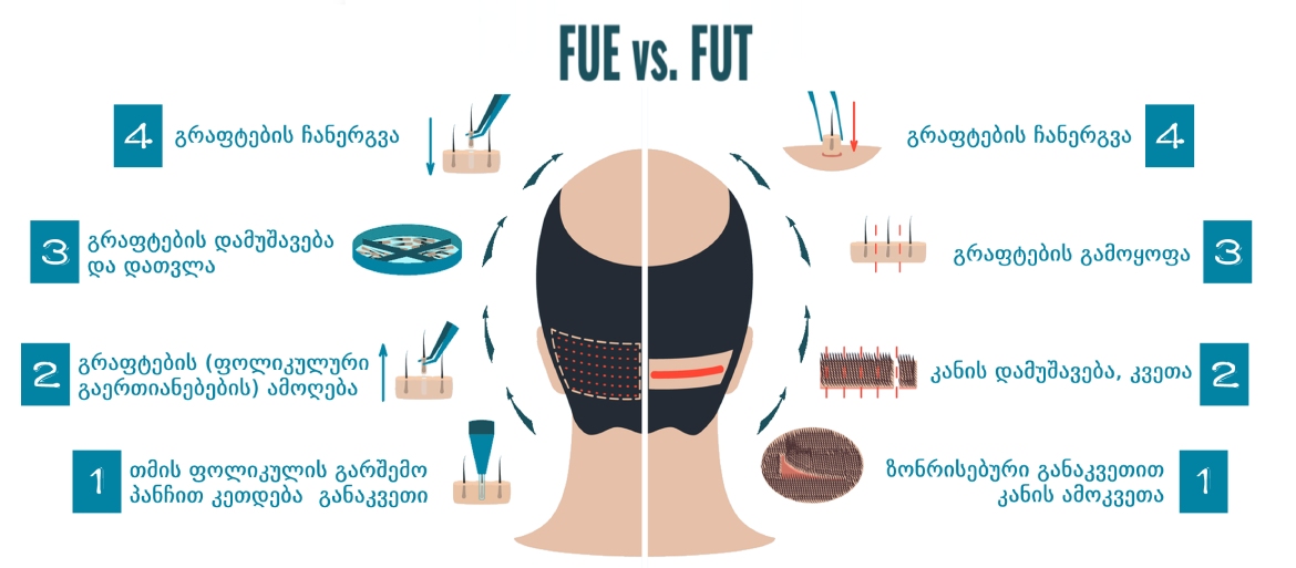 FUE VS FUT თმის გადანერგვის მეთოდები