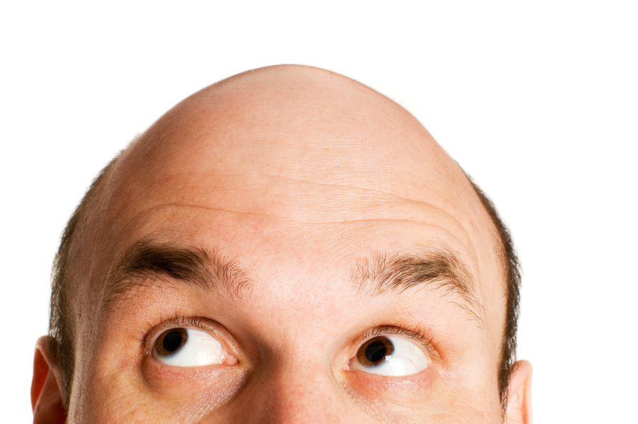 androgenetic alopecia