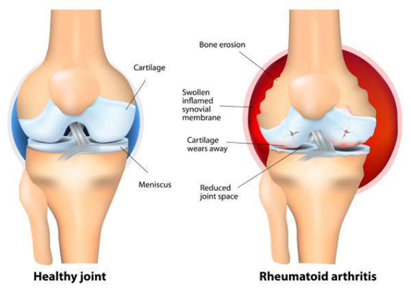 რევმატოიდული ართრიტი rheumatoid arthritis
