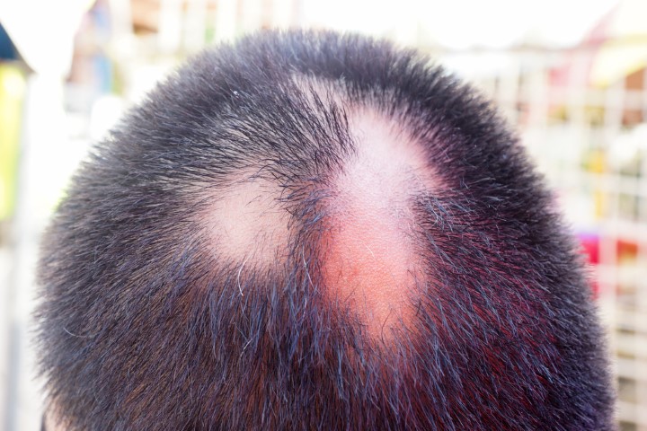 CICATRICAL ALOPECIA