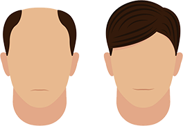 hair transplantation